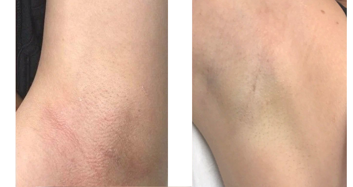 скидка на лазерную эпиляцию