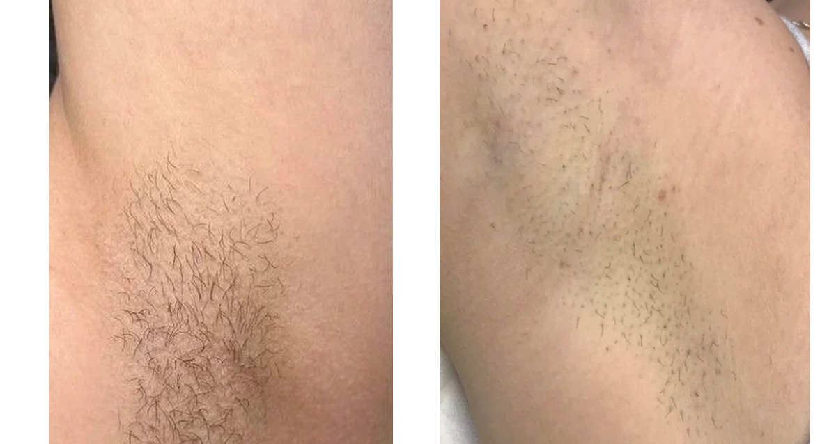 скидка на лазерную эпиляцию