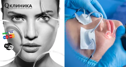 Скидки до 63% на лечение сосудов, пигмента, игольчатый RF, СО2 шлифовку