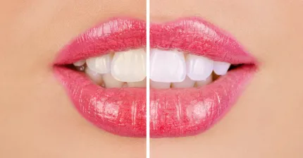 Скидки до 50% за отбеливание зубов