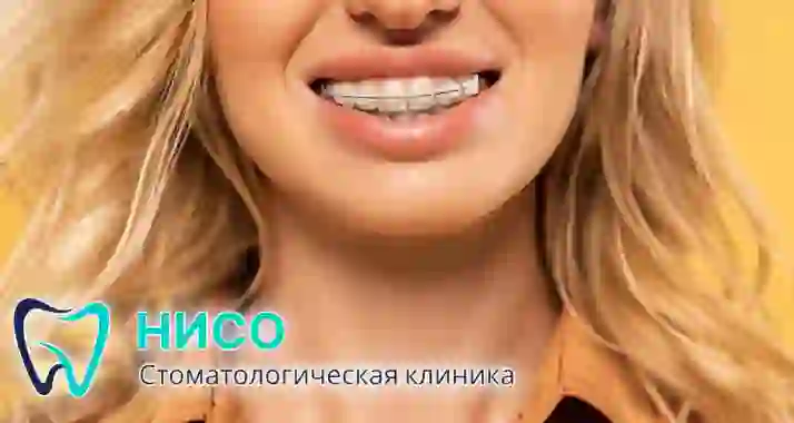 Скидка 30% на брекеты «под ключ» от стоматологии «Нисо»