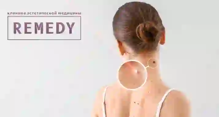 Скидки до 90% на удаление новообразований и сосудов