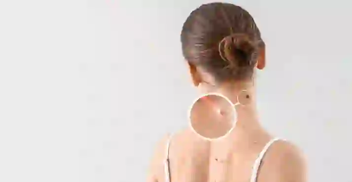 Скидки до 90% на удаление новообразований и сосудов