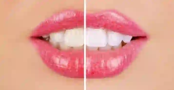 Скидки до 50% за отбеливание зубов