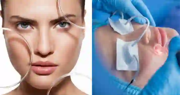 Скидки до 63% на лечение сосудов, пигмента, игольчатый RF, СО2 шлифовку